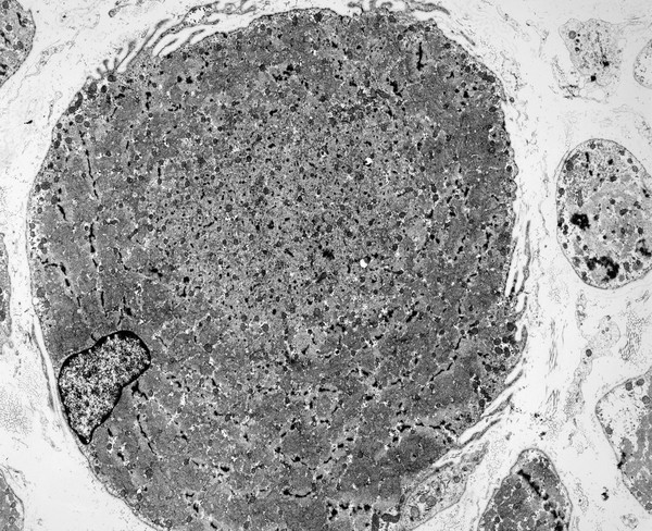 Muscle biopsy showing individual fibre- TS
