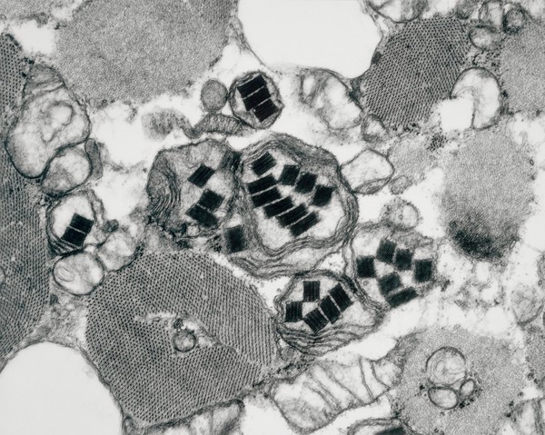 Mitochondrial inclusions in muscle biopsy
