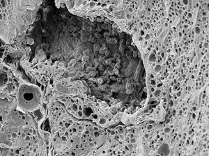 view Blood vessel in a melanoma, SEM