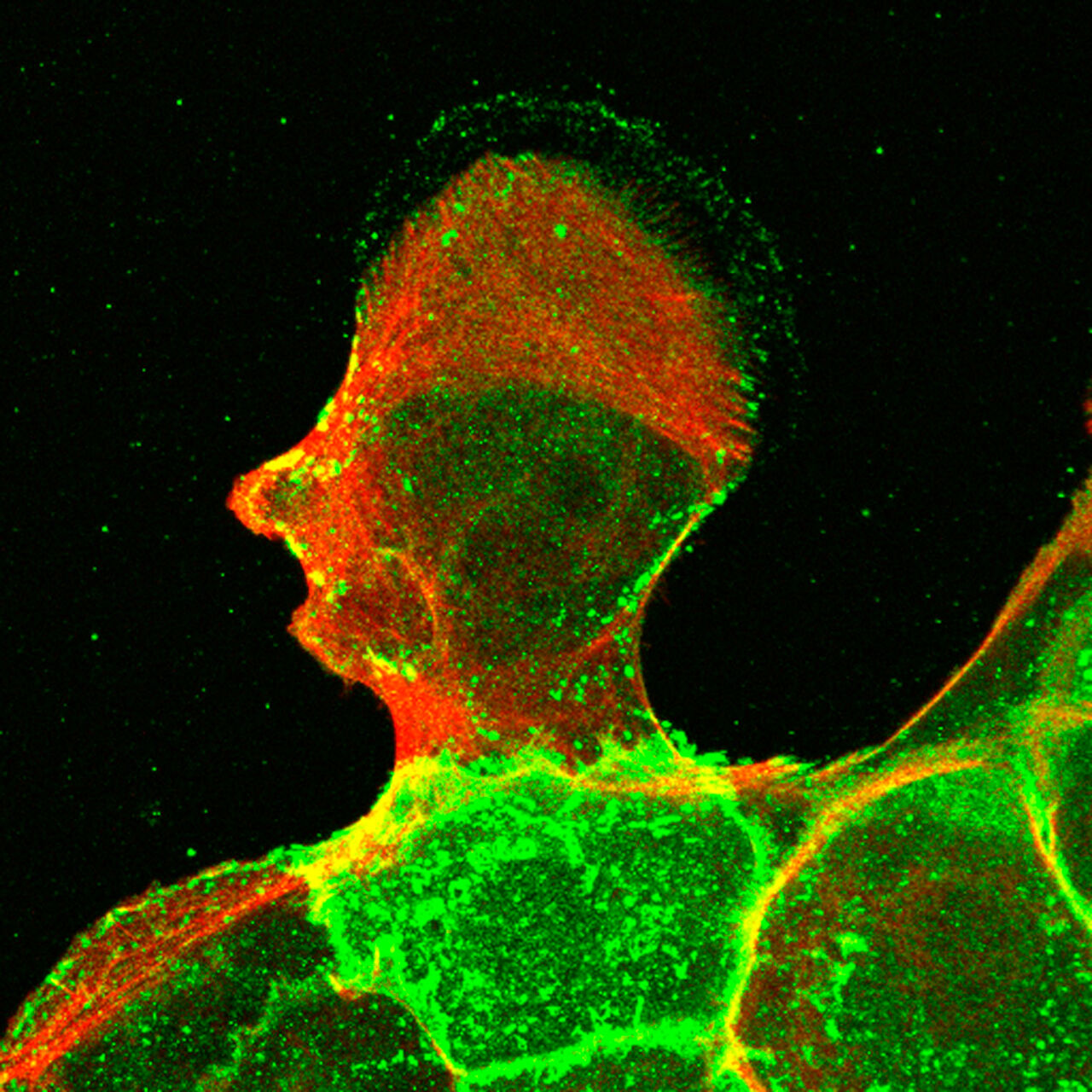 Malignant keratinocytes stained to show the, by John Marshall