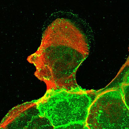Malignant keratinocytes stained to show the