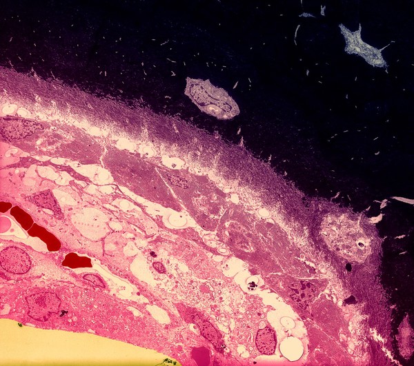 Calcified bone interface, col - red/purple