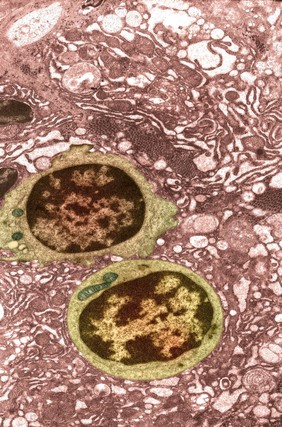 Lymphocytes and apoptotic plasma cells