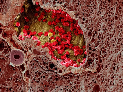 Blood vessel in a melanoma, SEM