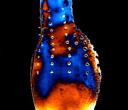 Abdominal aortic aneurysm