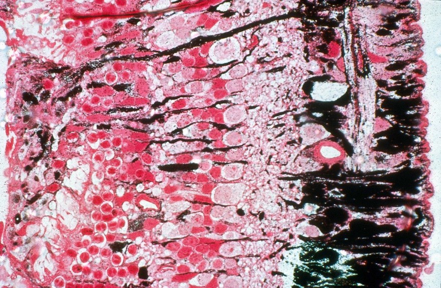 Scarring the a detached retina
