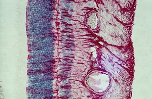 view Beginnings of retinal scarring