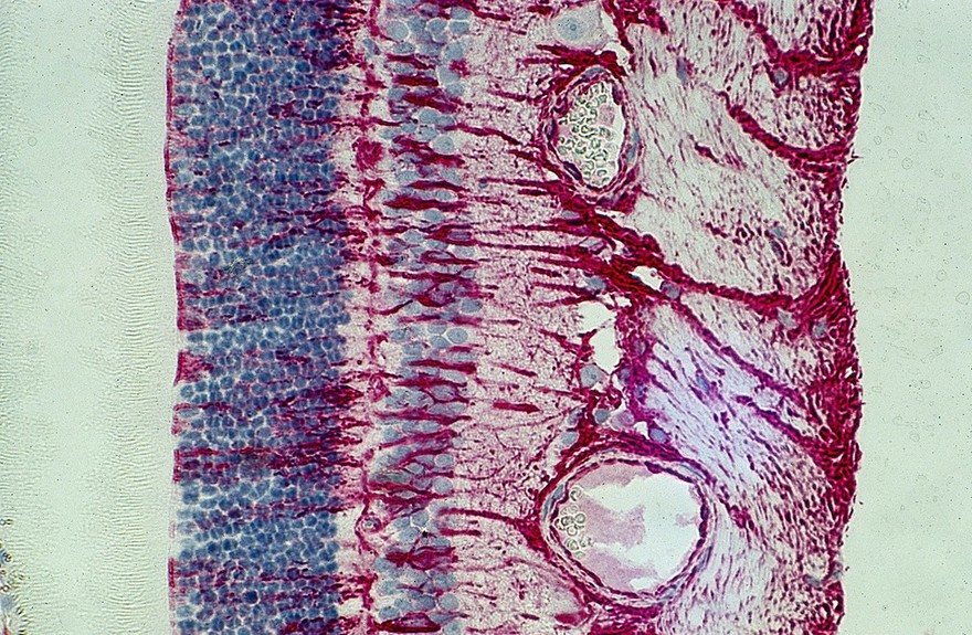 Beginnings of retinal scarring