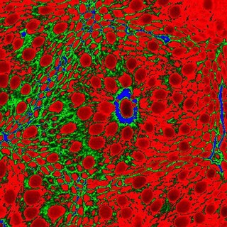 Normal, colonic crypt with mucin cells