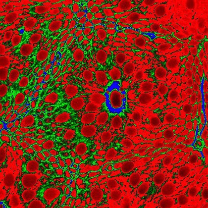 Normal, colonic crypt with mucin cells