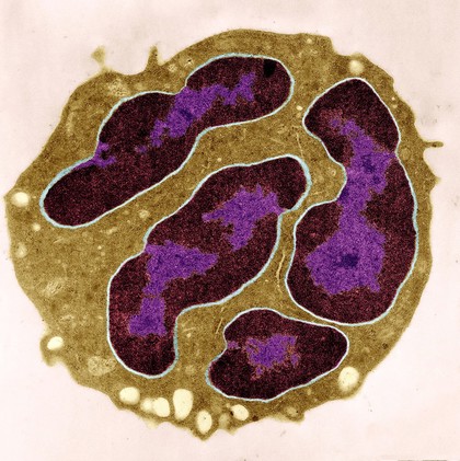 White blood cell - polymorphonuclear leucocyte