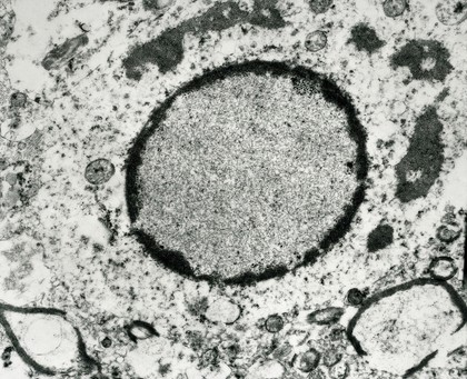 Measles infection in a brain cell nucleus