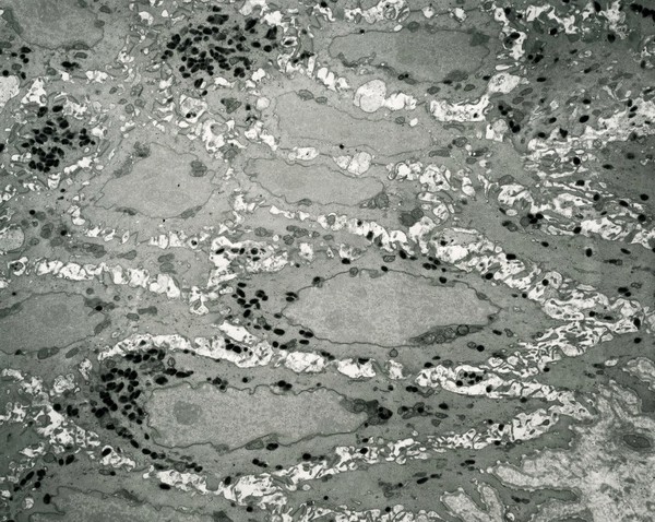 Melanocytes with melanin granules