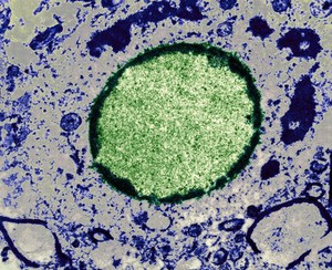 view Measles infection in a brain cell nucleus