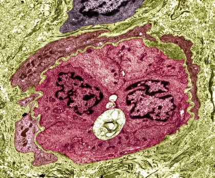 Occluded capillary