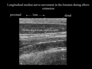 view Nerve movement in forearm, elbow extension, ultrasound