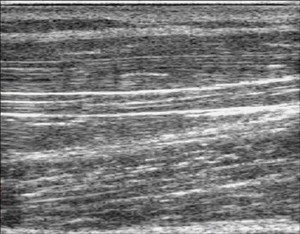 view Nerve movement in forearm, finger extension, ultrasound