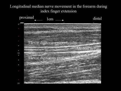 Nerve movement in forearm, finger extension, ultrasound