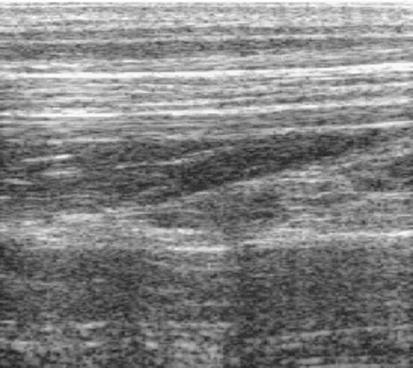 Nerve movement in forearm, ultrasound, hand joint extension
