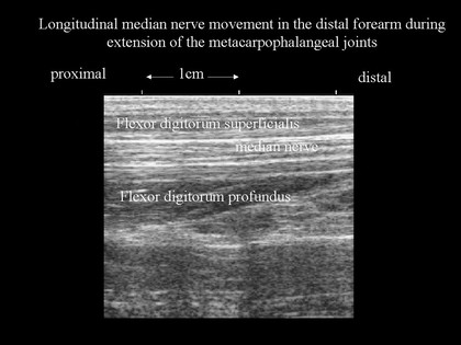 Nerve movement in forearm, ultrasound, hand joint extension