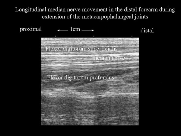 Nerve movement in forearm, ultrasound, hand joint extension