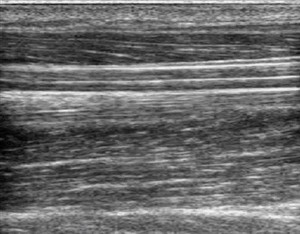 view Nerve movement in forearm, ultrasound, neck side flexion