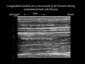 view Nerve movement in forearm, ultrasound, neck side flexion