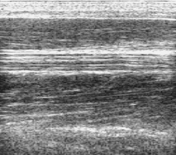 Nerve movement in forearm, ultrasound, shoulder adduction