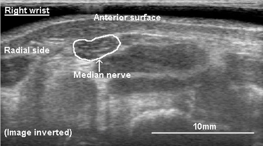 Nerve movement in forearm during typing, ultrasound