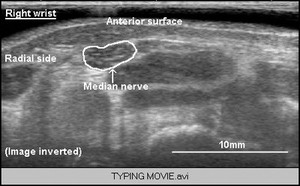 view Nerve movement in forearm during typing, ultrasound