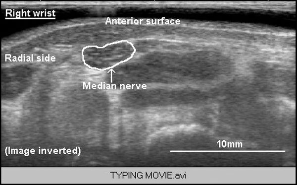 Nerve movement in forearm during typing, ultrasound