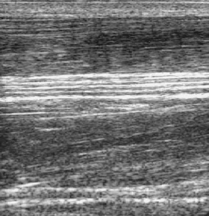 Nerve movement in forearm during wrist extension, ultrasound