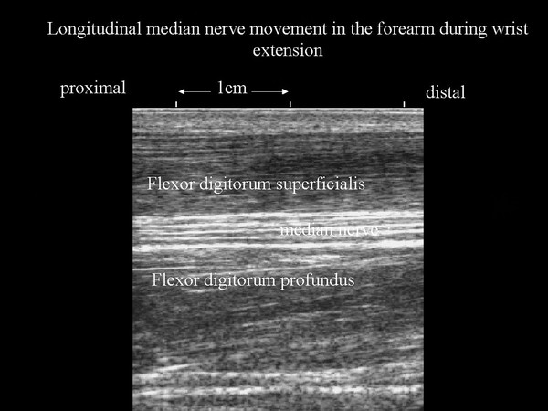 Nerve movement in forearm during wrist extension, ultrasound