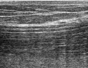 view Nerve movement in forearm during wrist extension, ultrasound