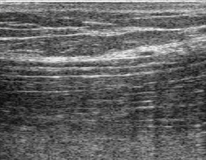 Nerve movement in forearm during wrist extension, ultrasound