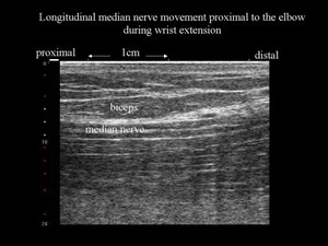 view Nerve movement in forearm during wrist extension, ultrasound