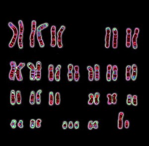 view Down syndrome human karyotype 47,XY,+21