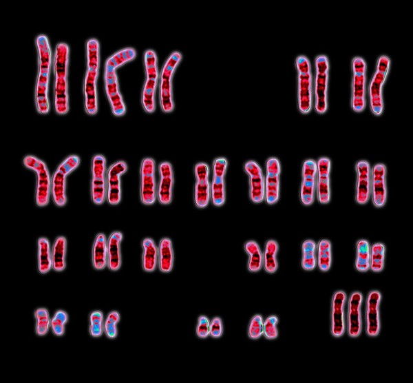 Triple-X chromosome aberration karyotype