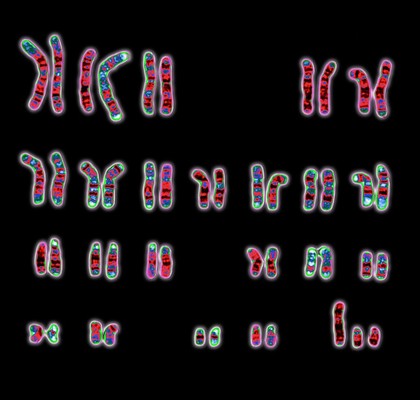 XYY syndrome karyotype 47,XYY