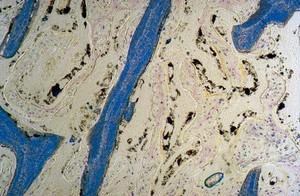 view New bone growth within a bioceramic bone substitute