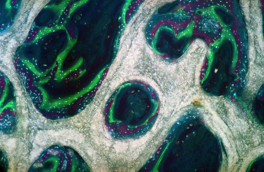 New bone growth within a bioceramic bone substitute