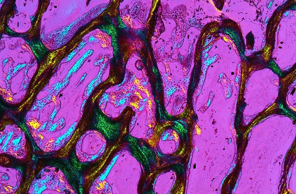 New bone growth within a bioceramic bone substitute