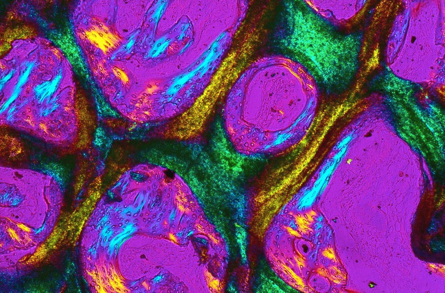 New bone growth within a bioceramic bone substitute