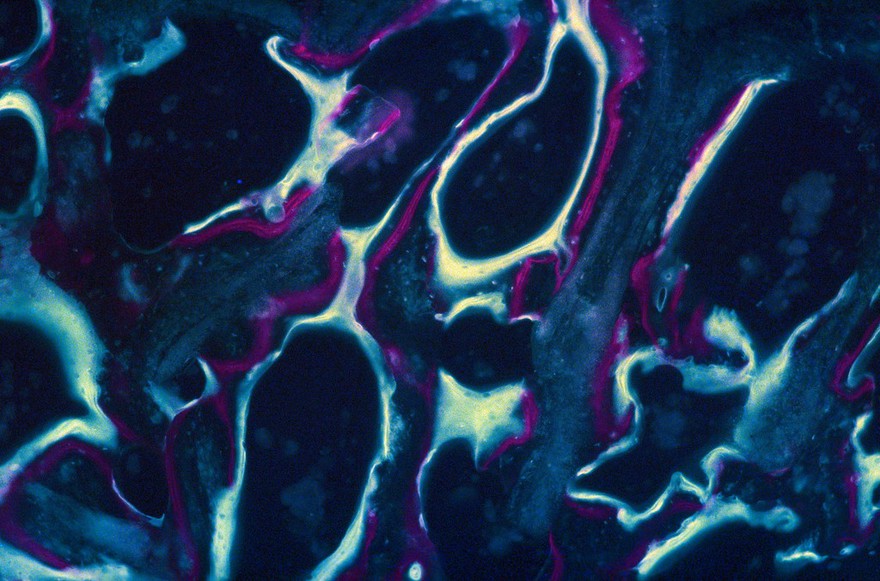 New bone growth within a bioceramic bone substitute