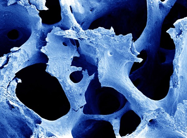 SEM of osteoporotic bone