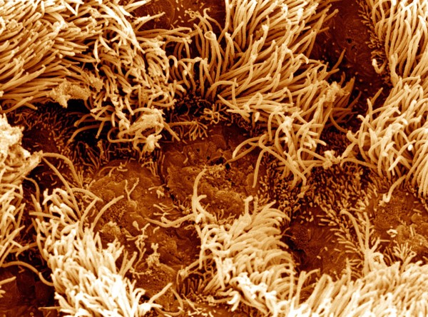 SEM bronchial surface of unhealthy lung