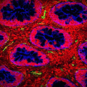 view Bacterial toxin in the intestine of a child