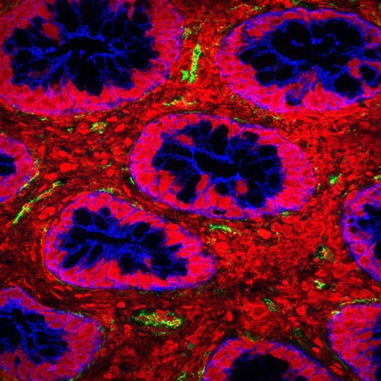 Bacterial toxin in the intestine of a child