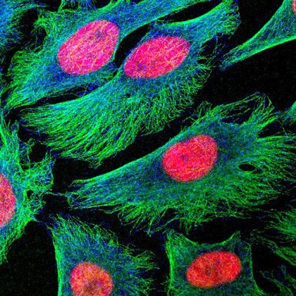 Human cancer cells in culture