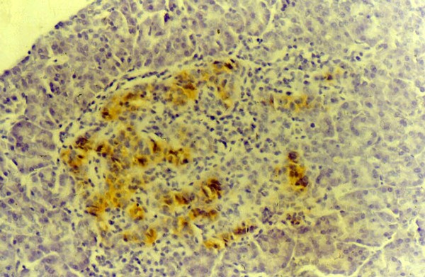 Destruction of islets of Langerhans in Type I diabetes